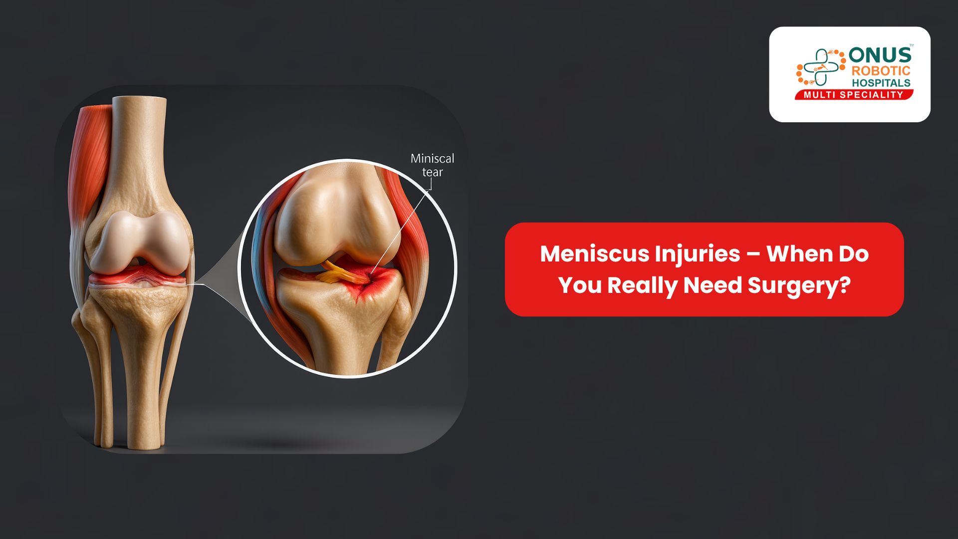 Meniscus Injuries – When Do You Really Need Surgery?: By Dr. Balaraju Naidu, Robotic Orthopedic Surgeon, ONUS Robotic Hospitals