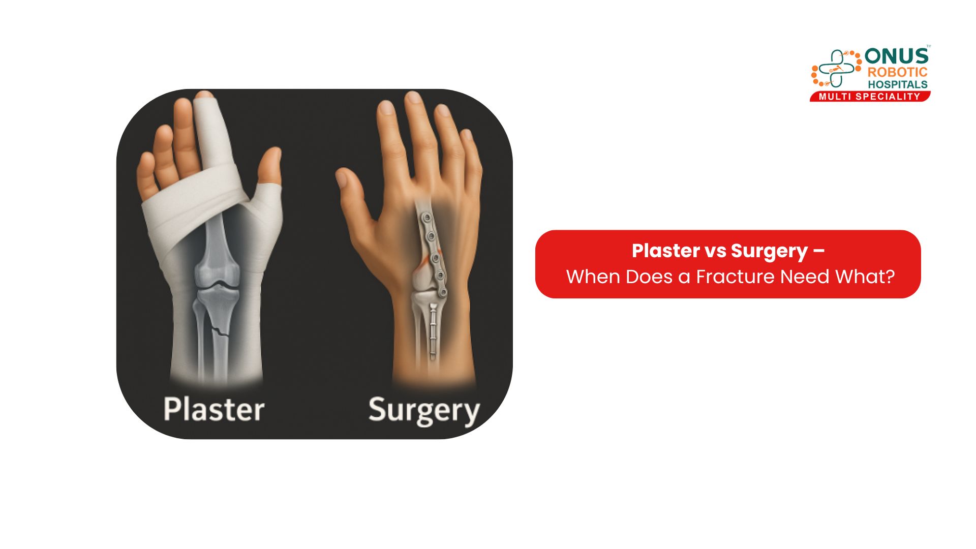 Plaster vs Surgery – When Does a Fracture Need What?: By Dr. Balaraju Naidu, Robotic Orthopedic Surgeon, ONUS Robotic Hospitals