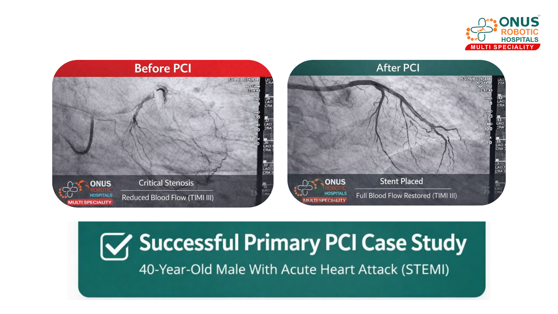 Case Study: Successful Primary PCI in a 40-Year-Old Male With Acute Heart Attack (STEMI)