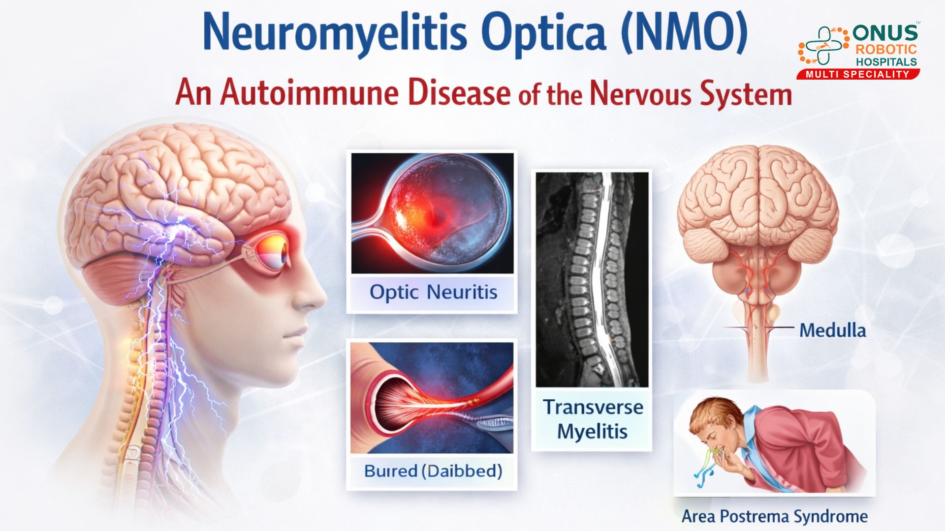 Neuromyelitis Optica (NMO): An Autoimmune Disease of the Nervous System – By Dr.Krishna Chaithanya Reddy, Neurologist, ONUS Robotic Hospitals