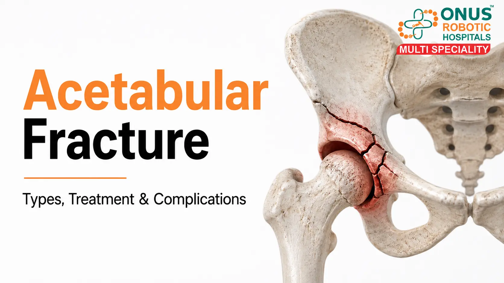 Acetabular Fracture: Types, Treatment & Complications- By Dr. Balaraju Naidu, Robotic Orthopedic Surgeon, ONUS Robotic Hospitals