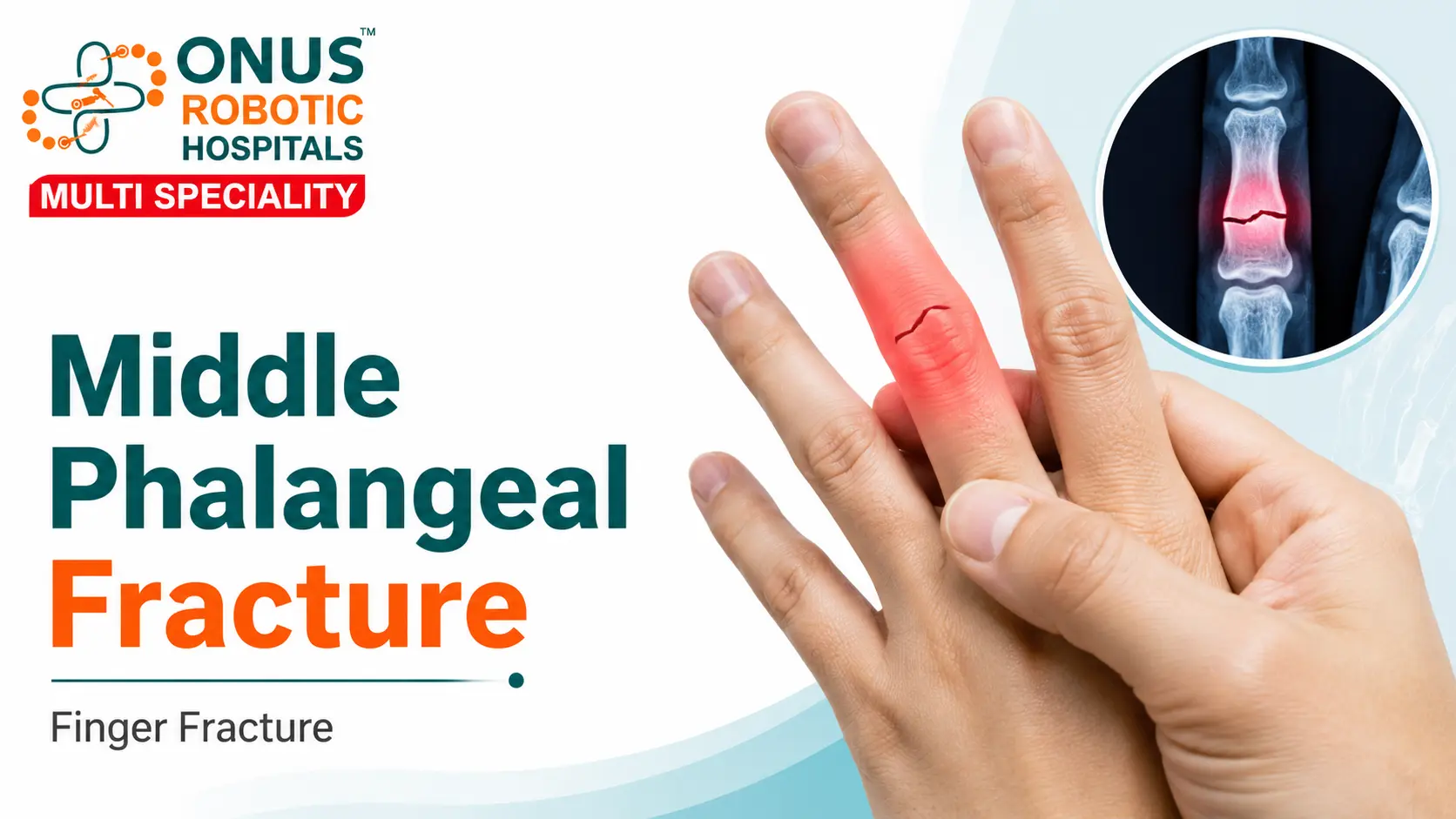 Middle Phalangeal Fracture: Causes, Symptoms, Diagnosis & Treatment- By Dr. Balaraju Naidu, Robotic Orthopedic Surgeon, ONUS Robotic Hospitals