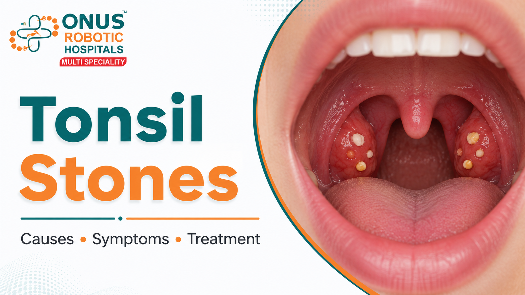 Tonsilloliths: Causes, Symptoms & Treatment for Tonsil Stones- By Dr. Akshitha Reddy, ENT Specialist, ONUS Robotic Hospitals