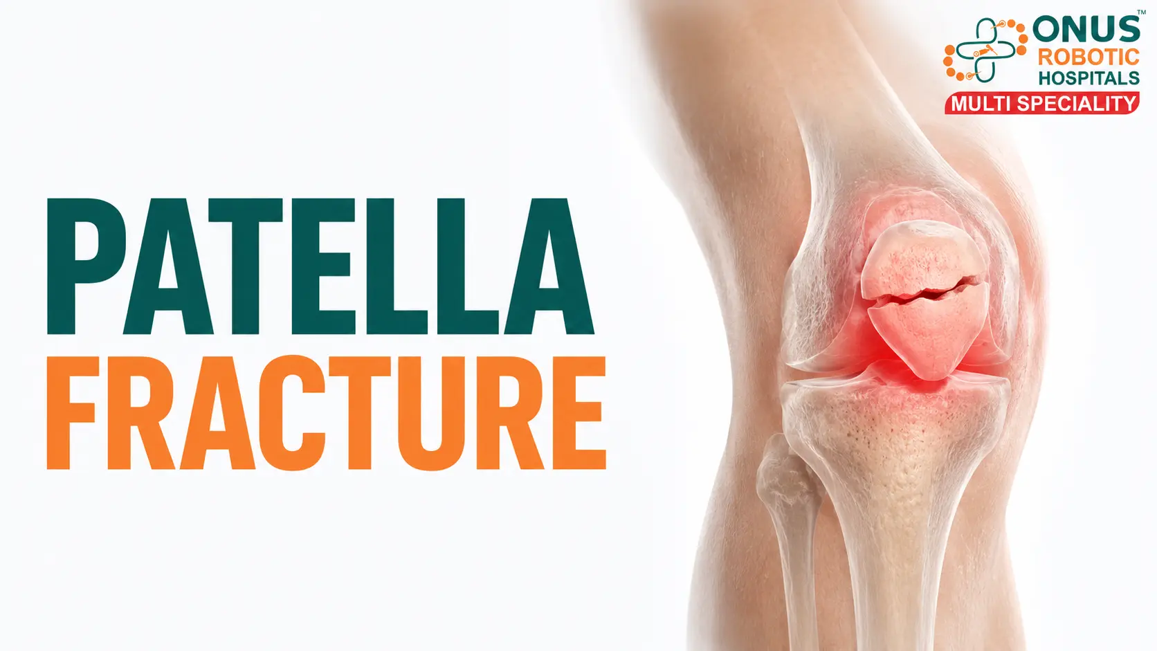Patella Fracture: Causes, Symptoms, Types & Treatment Options- By Dr. Balaraju Naidu, Robotic Orthopedic Surgeon, ONUS Robotic Hospitals