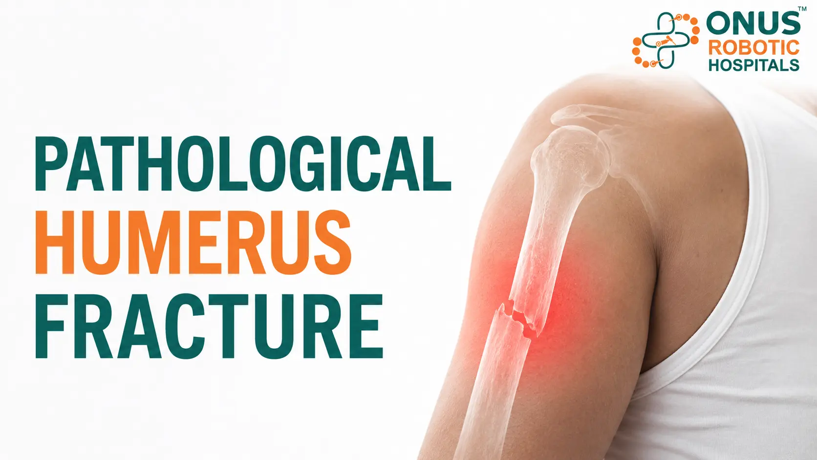 Pathological Fracture of Humerus: Causes, Symptoms & Treatment- By Dr. Balaraju Naidu, Robotic Orthopedic Surgeon, ONUS Robotic Hospitals