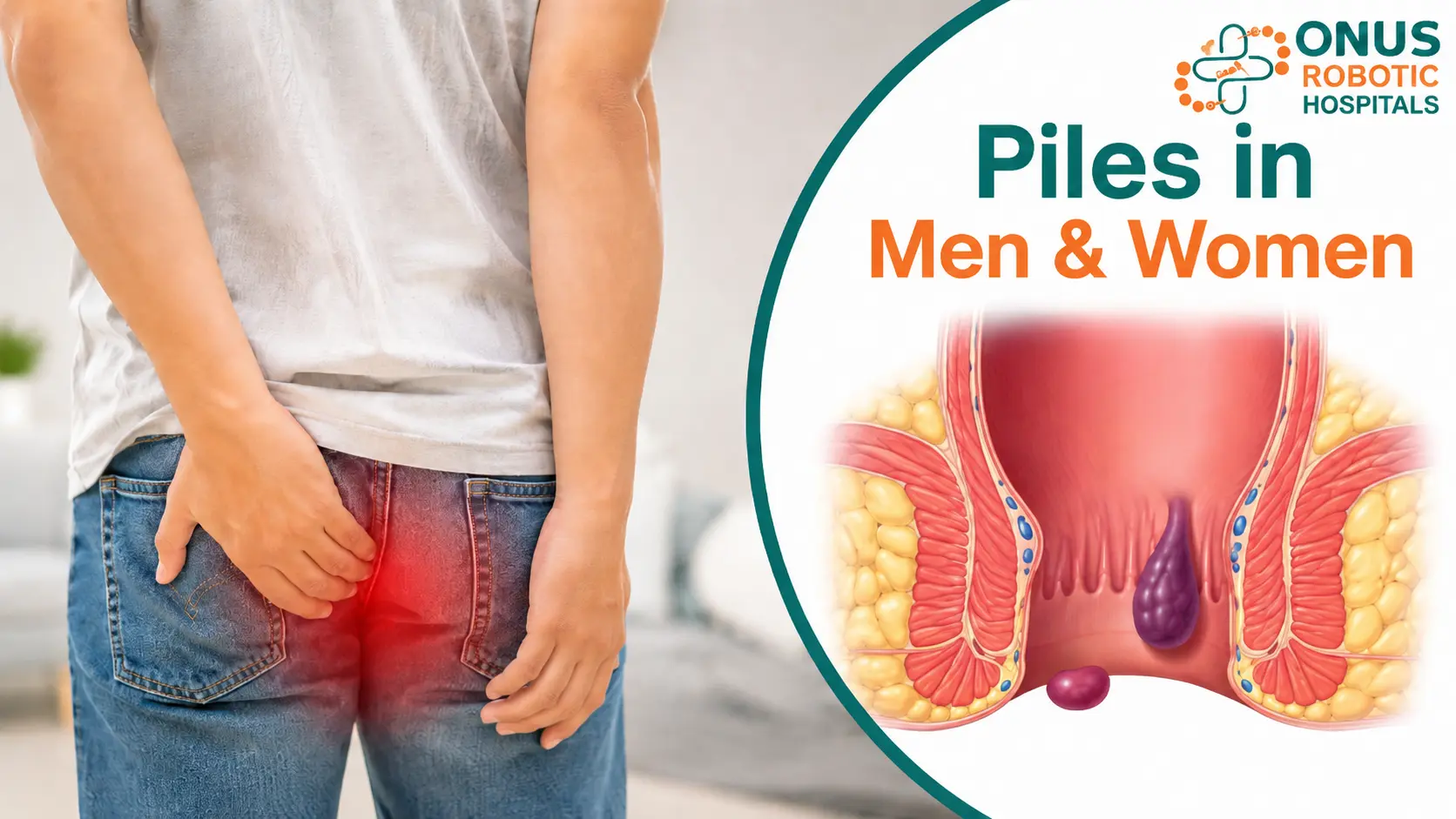 Piles in Men & Women: Causes, Symptoms, Risk Factors & Treatment Options- By Senior Consultant – General, Laser & Laparoscopic Surgery, ONUS Robotic Hospitals