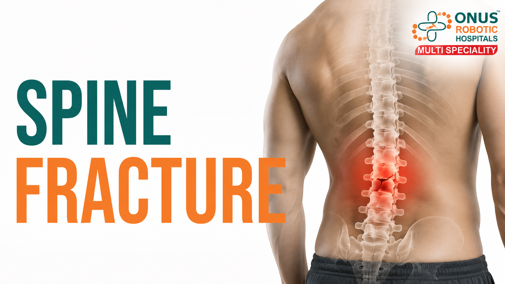 Spine Fractures: Causes, Symptoms, Diagnosis & Treatment Options- By Dr. Balaraju Naidu, Robotic Orthopedic Surgeon, ONUS Robotic Hospitals