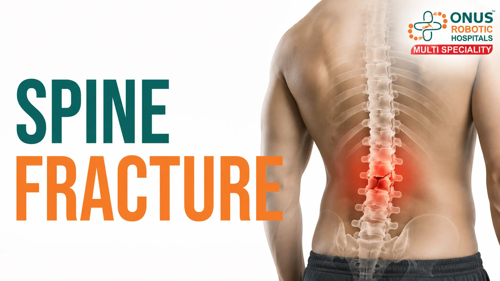 Spine Fractures: Causes, Symptoms, Diagnosis & Treatment Options- By Dr. Balaraju Naidu, Robotic Orthopedic Surgeon, ONUS Robotic Hospitals
