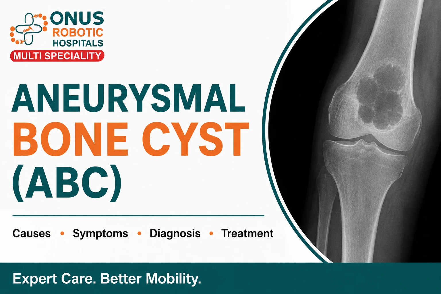 Aneurysmal Bone Cyst (ABC): Causes, Symptoms, Diagnosis, and Treatment- By Dr. Balaraju Naidu, Robotic Orthopedic Surgeon, ONUS Robotic Hospitals