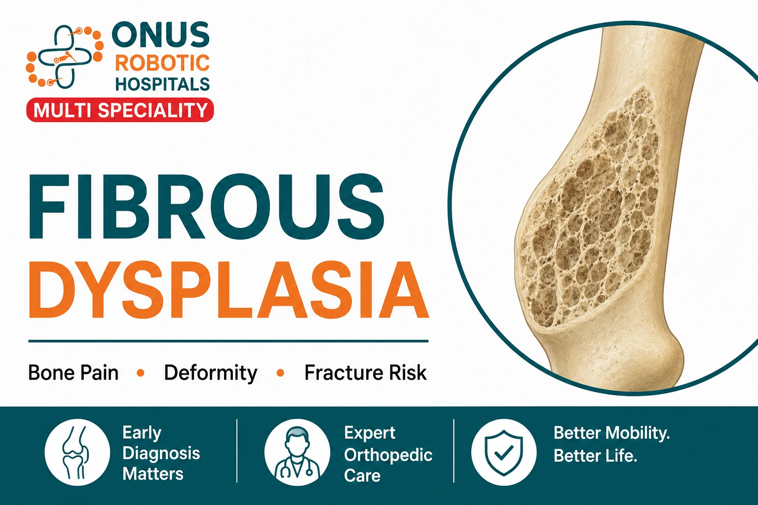 Fibrous Dysplasia: Causes, Symptoms, Diagnosis, and Treatment- By Dr. Balaraju Naidu, Robotic Orthopedic Surgeon, ONUS Robotic Hospitals