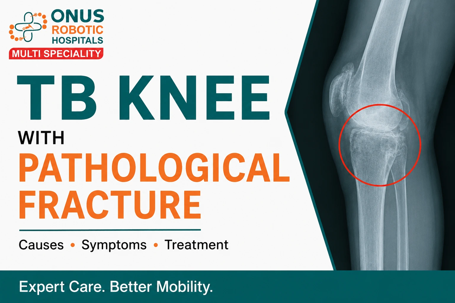 TB Knee with Pathological Fracture: Understanding a Serious Orthopedic Condition- By Dr. Balaraju Naidu, Robotic Orthopedic Surgeon, ONUS Robotic Hospitals