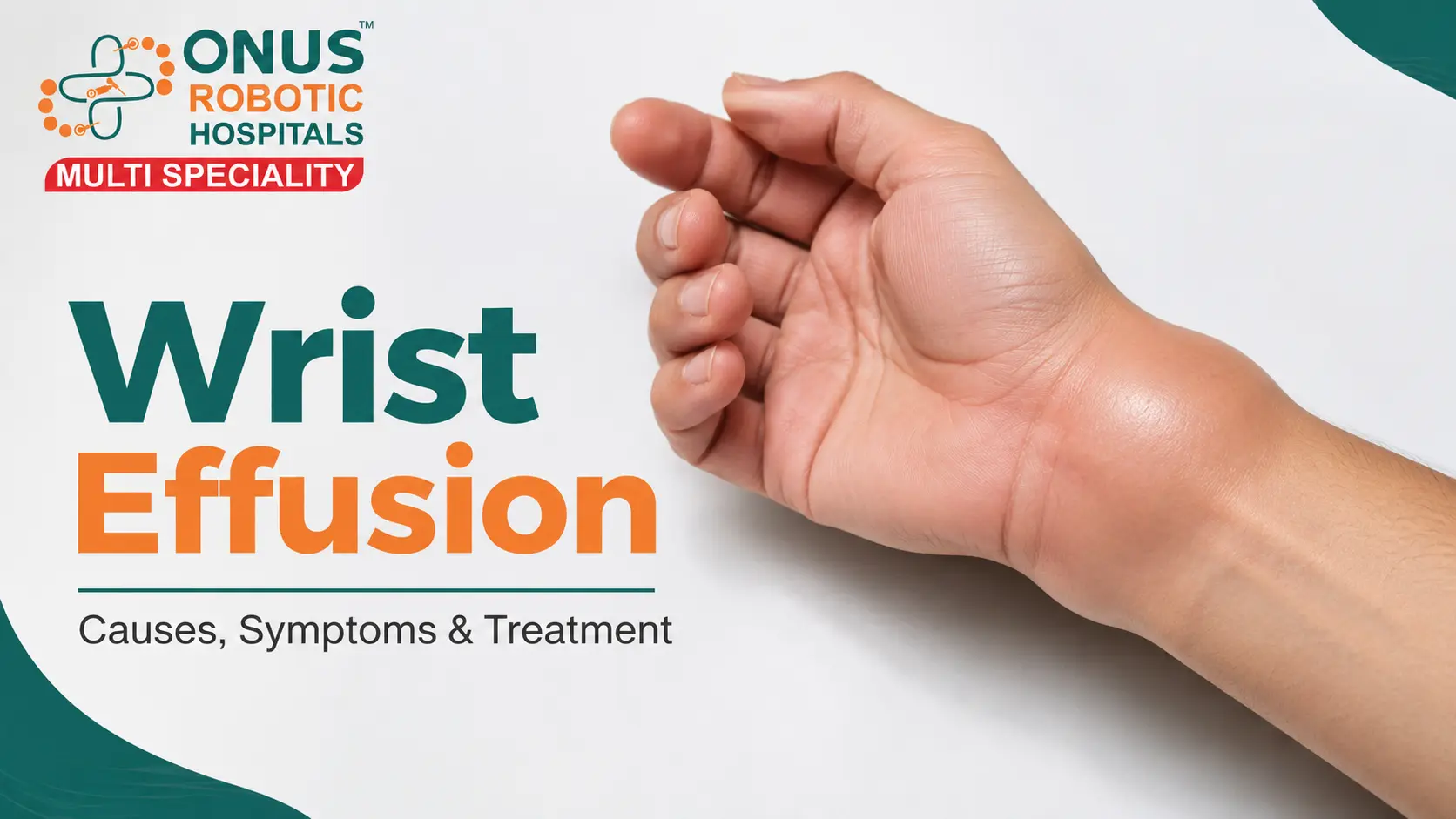 Wrist Effusion: Causes, Symptoms, Diagnosis & Treatment- By Dr. Balaraju Naidu, Robotic Orthopedic Surgeon, ONUS Robotic Hospitals