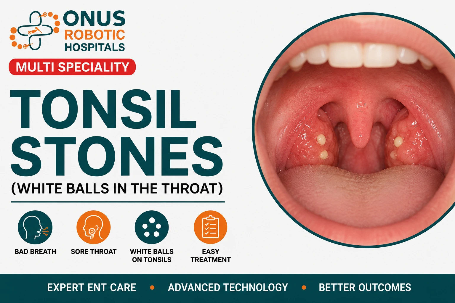 Tonsil Stones (White Balls in the Throat): Causes, Symptoms, and Treatment- By Consultant ENT Head & Neck Surgeon, ONUS Robotic Hospitals