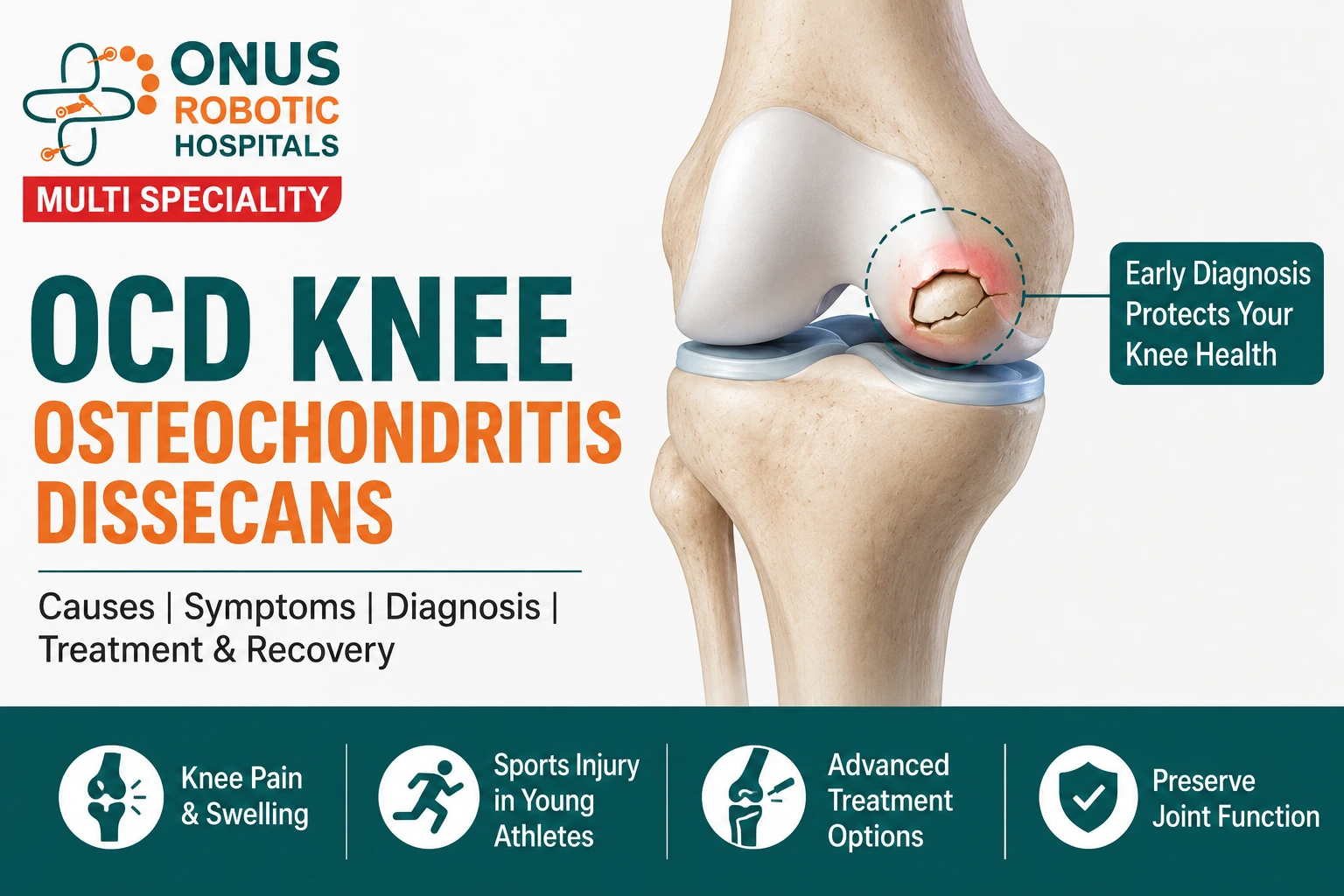 Osteochondritis Dissecans (OCD) of the Knee: Causes, Symptoms, Diagnosis & Treatment- By Dr. Balaraju Naidu, Robotic Orthopedic Surgeon, ONUS Robotic Hospitals