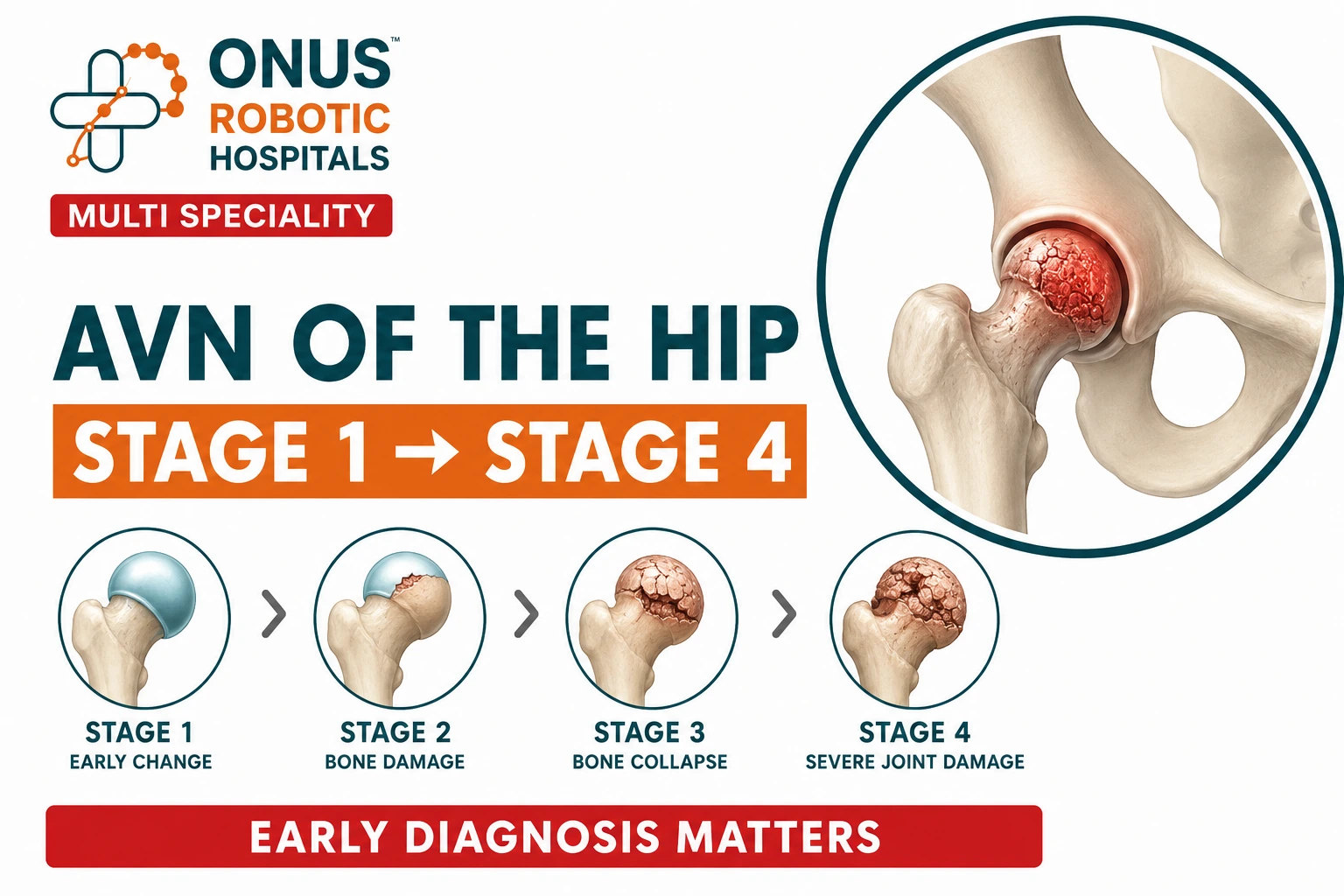 Avascular Necrosis (AVN) of the Hip – Understanding Stages 1 to 4 and Treatment Options- By Dr. Balaraju Naidu, Robotic Orthopedic Surgeon, ONUS Robotic Hospitals